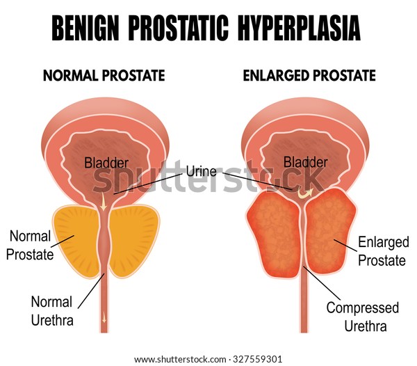 hiperplasia prostática benigna que significa en hindi