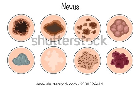 A benign skin neoplasm consisting of pigmented cells. Different types of age spots that occur on people's skin. Color vector illustration on the theme of dermatology and cosmetology.