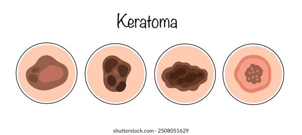 Una neoplasia benigna de la piel se formó a partir del estrato córneo de la epidermis. Principales tipos de queratoma dibujados a mano. Ilustración vectorial de color sobre el tema de las enfermedades de la piel.