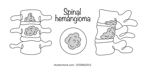 Um tumor benigno que consiste em células endoteliais vasculares cheias de sangue. Hemangioma espinhal desenhado à mão. Ilustração de vetor simples para usos diferentes.