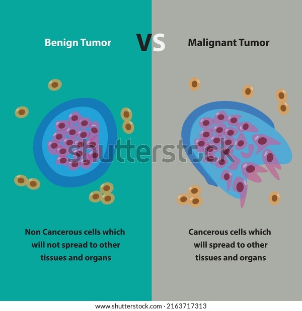 Benign Tumor\
vs Malignant Tumor cell, cancer\
cells