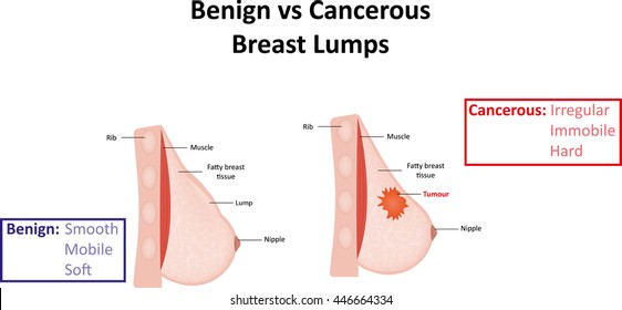 Benign Vs Cancerous Breast Lumps