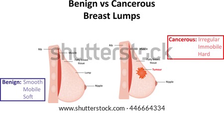 breast cysts benign Hogtied with anal hook