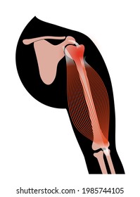 Biceps tear concept. Trauma in human arms. Pain and disease in human muscular system. Bones and joints in male silhouette. Anatomical poster of biceps and triceps. Medical vector illustration of hand