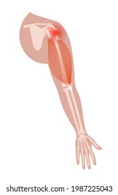 Biceps tear concept. Trauma in human arms. Pain and disease in human muscular system. Bones and joints in male silhouette. Anatomical poster of biceps and triceps. Medical vector illustration of hand