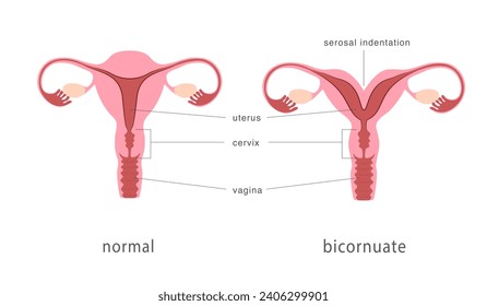 Bicornuate and normal human uterus structure. Uterine deep septum as a congenital uterine malformation. Anatomy chart. Vector illustration