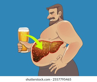 Big man drinks beer. Alcohol belly. The harm of alcohol. Liver disease. Cirrhosis of the liver. Social illustration. Healthcare illustration. Vector illustration.