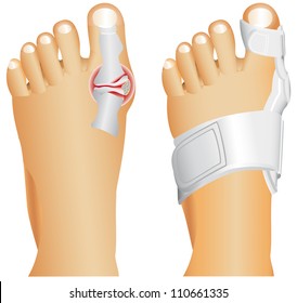 Big toe injury. Support for foot or big toe injury. Hallufix Hallux Valgus Splint. Bunion, Hallux valgus, popularly known as Bunion.