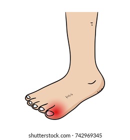 Big Toe Are Red And Bruised Because Of Injury,Hand Drawn,Vector,Illustration.