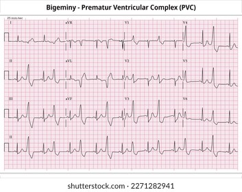 Bigeminy - vorreifer ventrikulärer Komplex (PVC) - ventrikulärer Frühbeat (VPB) - ECG-Papier 12 Blei - Elektrokardiogramm Vektor-Medizinische Illustration