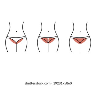 Bikini area depilation. Silhouette of a woman. Vector illustration.