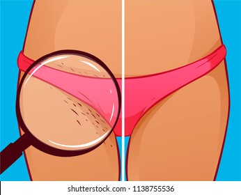 Bikini shaving, vector illustration