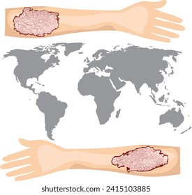 bilateral psoriasis on extensor of the upper limb