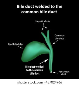 Bile duct welded to the common bile duct. Pathology of the gallbladder. Cholecystitis. The structure of the gallbladder. Infographics. Vector illustration.