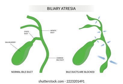 Biliary Atresia Anatomy Of Blocked Bile Duct Disease