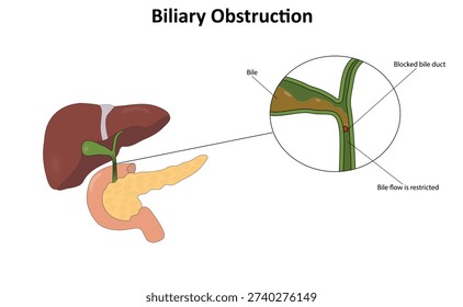Biliary obstruction vector illustration. Bile duct blockage