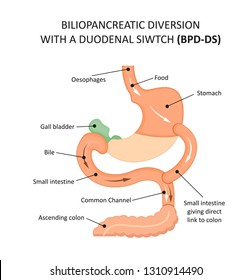 Biliopancreatic diversion  (bpd)