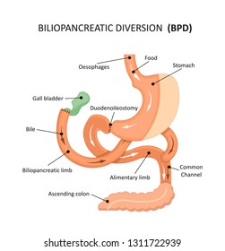 Biliopancreatic Diversion
With A Duodenal Siwtch (BPD-DS) 
 

