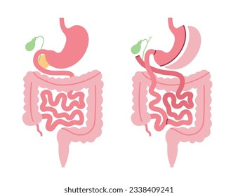 Biliopancreatic diversion with duodenal switch. BPD stomach surgery, weight loss gastric procedure. Internal organs before and after operation. Overweight and obesity problem flat vector illustration