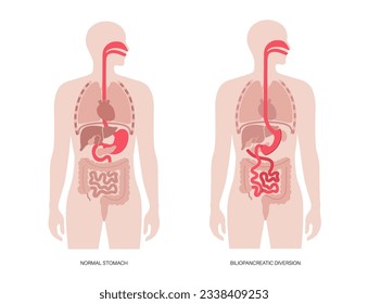 Biliopancreatische Umleitung mit Duodenalschalter. BPD Magenoperation, Gewichtsverlust Magenoperation. Innere Organe vor und nach der Operation. Übergewicht und Fettleibigkeit Problem flache Vektorgrafik