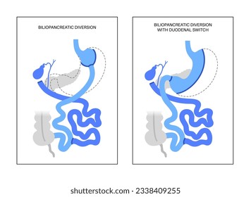 Biliopancreatic diversion with duodenal switch. BPD stomach surgery, weight loss gastric procedure. Internal organs before and after operation. Overweight and obesity problem flat vector illustration