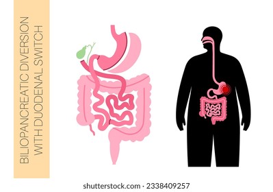 Biliopancreatic diversion with duodenal switch. BPD stomach surgery concept, weight loss gastric procedure. Abdomen laparoscopy. Overweight and obesity in human body flat vector medical illustration