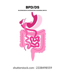 Biliopancreatic diversion with duodenal switch. BPD stomach surgery concept, weight loss gastric procedure. Abdomen laparoscopy. Overweight and obesity in human body flat vector medical illustration