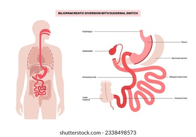 Biliopancreatic diversion with duodenal switch. BPD stomach surgery concept, weight loss gastric procedure. Abdomen laparoscopy. Overweight and obesity in human body flat vector medical illustration