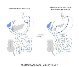 Biliopancreatic diversion with duodenal switch. BPD stomach surgery, weight loss gastric procedure. Internal organs before and after operation. Overweight and obesity problem flat vector illustration