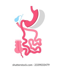 Biliopancreatic diversion with duodenal switch. BPD stomach surgery concept, weight loss gastric procedure. Abdomen laparoscopy. Overweight and obesity in human body flat vector medical illustration