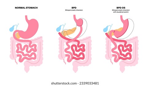 Biliopancreatic diversion with duodenal switch. BPD stomach surgery, weight loss gastric procedure. Internal organs before and after operation. Overweight and obesity problem flat vector illustration