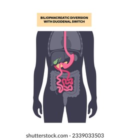 Biliopancreatic diversion with duodenal switch. BPD stomach surgery concept, weight loss gastric procedure. Abdomen laparoscopy. Overweight and obesity in human body flat vector medical illustration