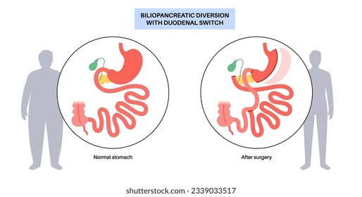 Biliopancreatic diversion with duodenal switch. BPD stomach surgery, weight loss gastric procedure. Internal organs before and after operation. Overweight and obesity problem flat vector illustration