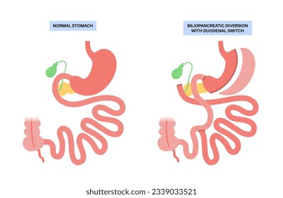 Biliopancreatic diversion with duodenal switch. BPD stomach surgery, weight loss gastric procedure. Internal organs before and after operation. Overweight and obesity problem flat vector illustration