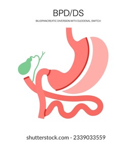 Biliopancreatic diversion with duodenal switch. BPD stomach surgery concept, weight loss gastric procedure. Abdomen laparoscopy. Overweight and obesity in human body flat vector medical illustration