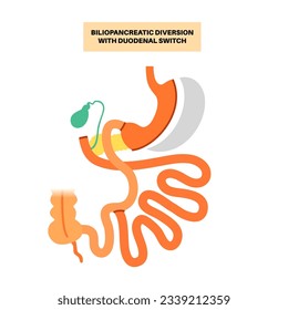 Biliopancreatic diversion with duodenal switch. BPD stomach surgery concept, weight loss gastric procedure. Abdomen laparoscopy. Overweight and obesity in human body flat vector medical illustration