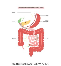 Biliopancreatic diversion with duodenal switch. BPD stomach surgery concept, weight loss gastric procedure. Abdomen laparoscopy. Overweight and obesity in human body flat vector medical illustration