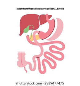 Biliopancreatic diversion with duodenal switch. BPD stomach surgery concept, weight loss gastric procedure. Abdomen laparoscopy. Overweight and obesity in human body flat vector medical illustration