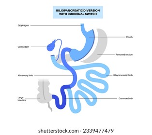 Biliopancreatic diversion with duodenal switch. BPD stomach surgery concept, weight loss gastric procedure. Abdomen laparoscopy. Overweight and obesity in human body flat vector medical illustration