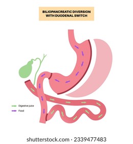 Biliopancreatic diversion with duodenal switch. BPD stomach surgery concept, weight loss gastric procedure. Abdomen laparoscopy. Overweight and obesity in human body flat vector medical illustration