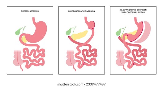 Biliopancreatic diversion with duodenal switch. BPD stomach surgery, weight loss gastric procedure. Internal organs before and after operation. Overweight and obesity problem flat vector illustration