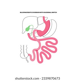 Biliopancreatic diversion with duodenal switch. BPD stomach surgery concept, weight loss gastric procedure. Abdomen laparoscopy. Overweight and obesity in human body flat vector medical illustration