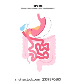 Biliopancreatic diversion with duodenal switch. BPD stomach surgery concept, weight loss gastric procedure. Abdomen laparoscopy. Overweight and obesity in human body flat vector medical illustration