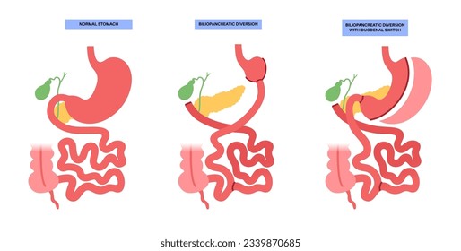 Biliopancreatic diversion with duodenal switch. BPD stomach surgery, weight loss gastric procedure. Internal organs before and after operation. Overweight and obesity problem flat vector illustration