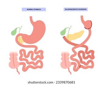 Biliopancreatic diversion gastroplasty. BPD stomach surgery, weight loss gastric procedure. Abdomen laparoscopy. Internal organs before and after operation. Overweight problem flat vector illustration