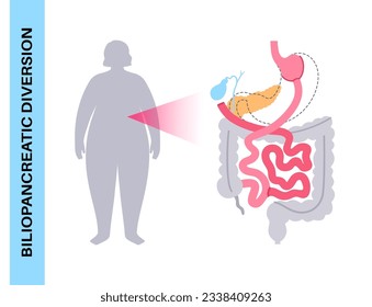 Biliopancreatic diversion gastroplasty operation. BPD stomach surgery, weight loss gastric procedure. Abdomen laparoscopy. Overweight problem, female silhouette with obesity flat vector illustration