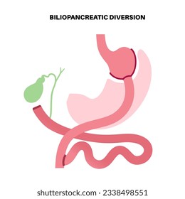 Biliopancreatic diversion gastroplasty operation. BPD stomach surgery concept, weight loss gastric procedure. Abdomen laparoscopy. Overweight problem in human body flat vector medical illustration