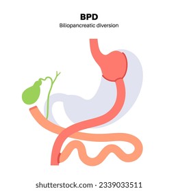 Biliopancreatic diversion gastroplasty operation. BPD stomach surgery concept, weight loss gastric procedure. Abdomen laparoscopy. Overweight problem in human body flat vector medical illustration