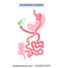 Biliopancreatic diversion gastroplasty operation. BPD stomach surgery concept, weight loss gastric procedure. Abdomen laparoscopy. Overweight problem in human body flat vector medical illustration