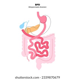 Biliopancreatic diversion gastroplasty operation. BPD stomach surgery concept, weight loss gastric procedure. Abdomen laparoscopy. Overweight problem in human body flat vector medical illustration